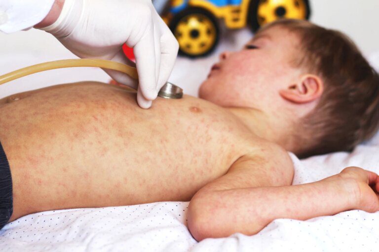 Doctors’ warning amid rising cases of measles in children.  5 symptoms to watch out for